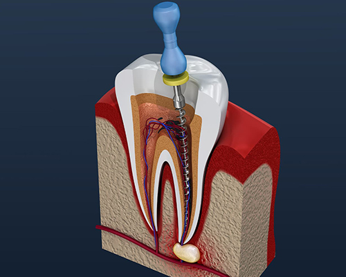 Root canal treatment in Thane West