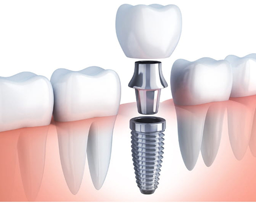 Dental implants in Thane West