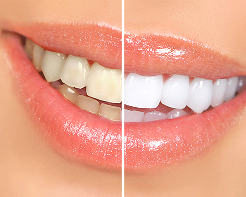 Teeth whitening in Thane West